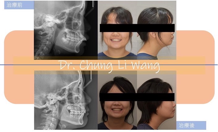 矯正案例 – 暴牙合併深咬
