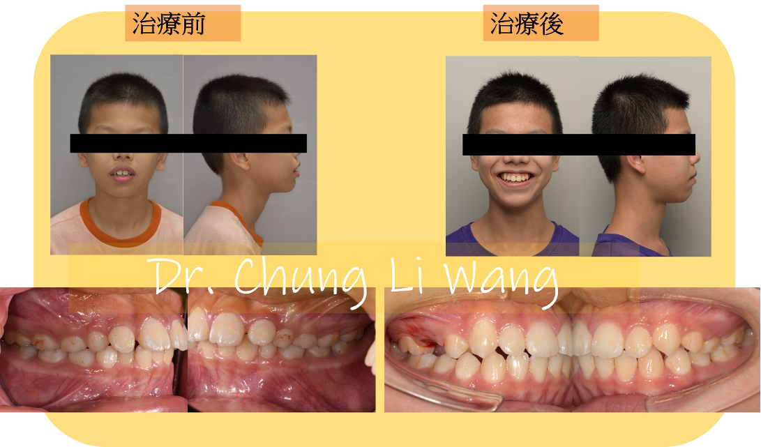 矯正案例 – 肌功能訓練器