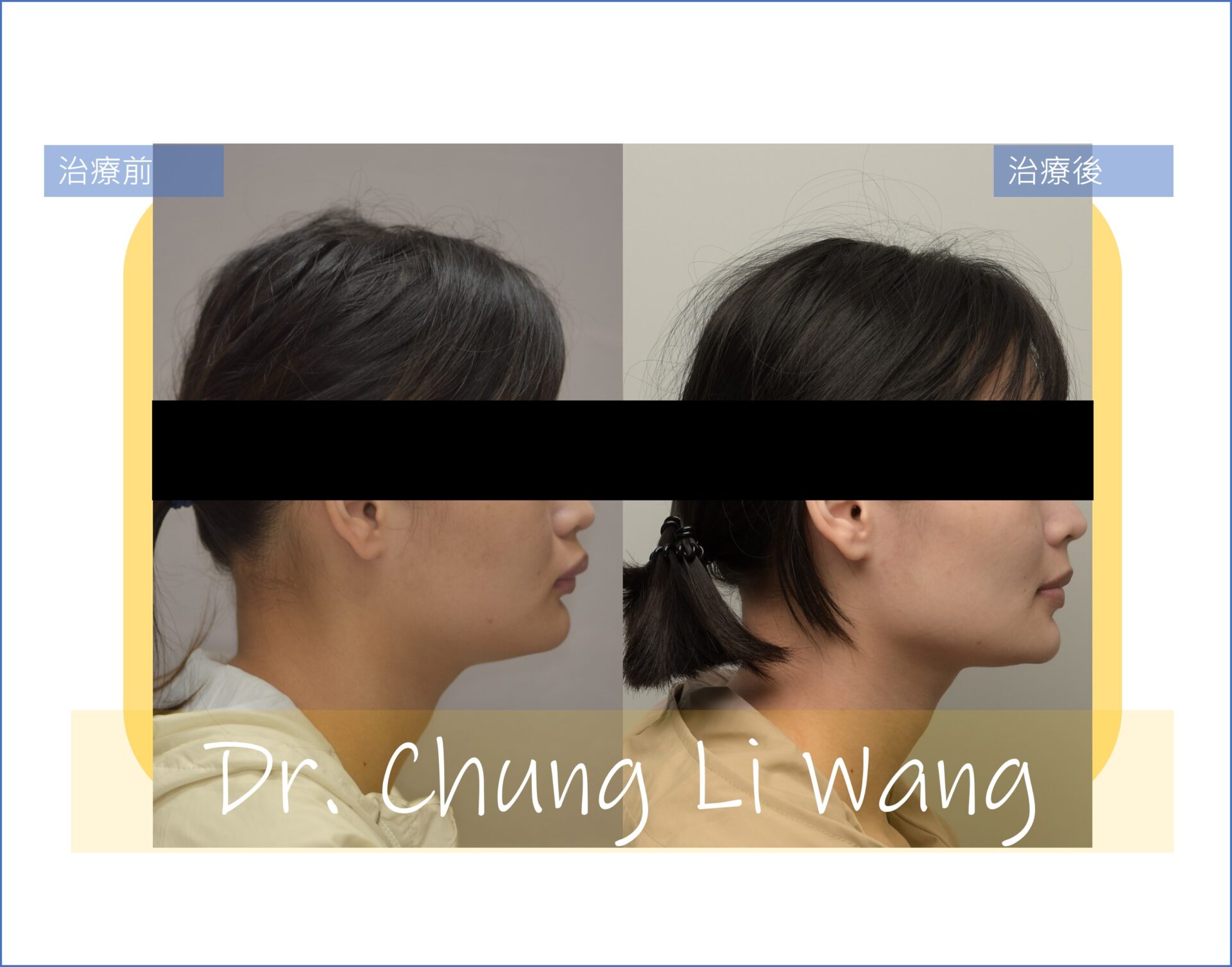 矯正案例 – 暴牙合併深咬