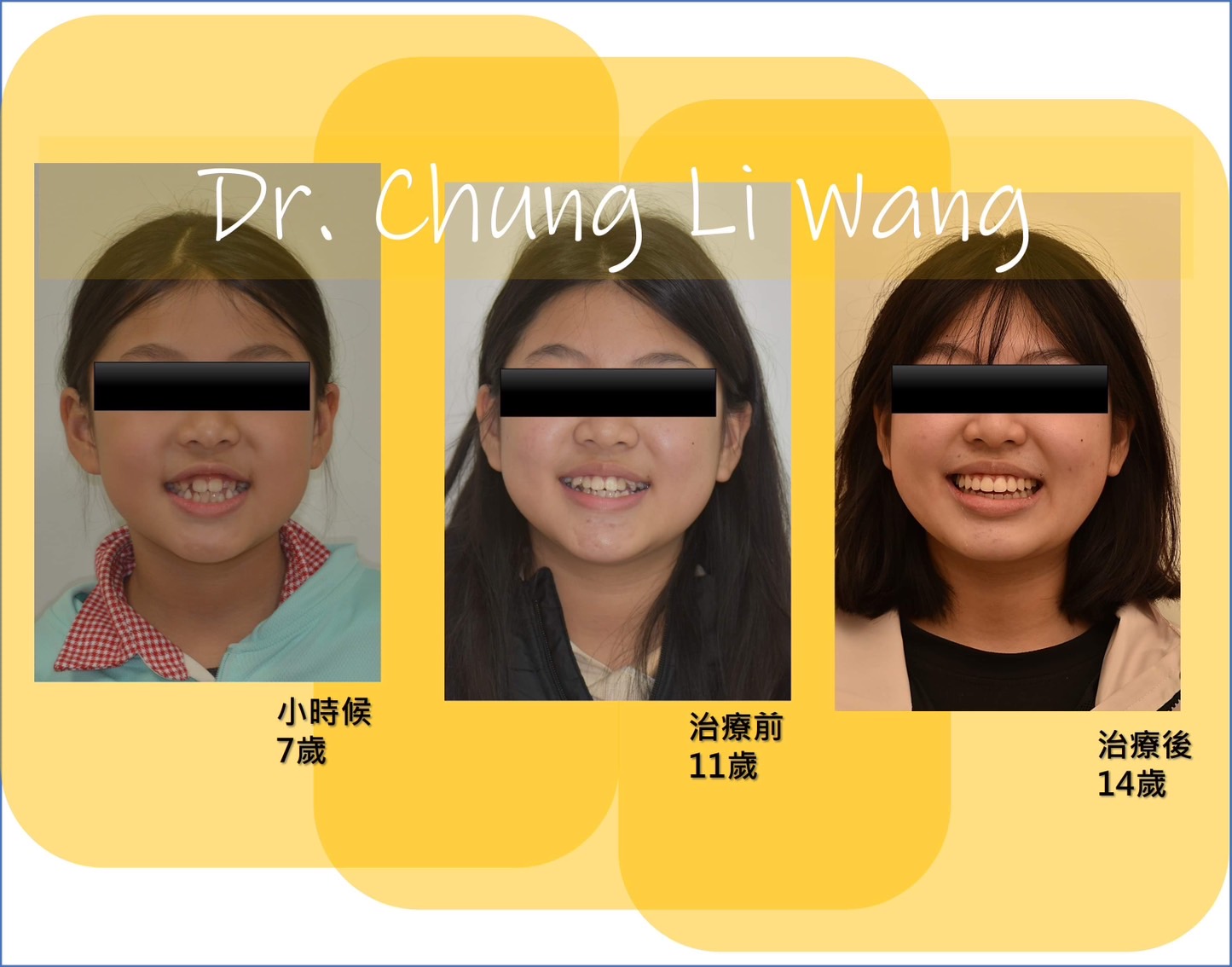 齒列擁擠 (早期追蹤 )