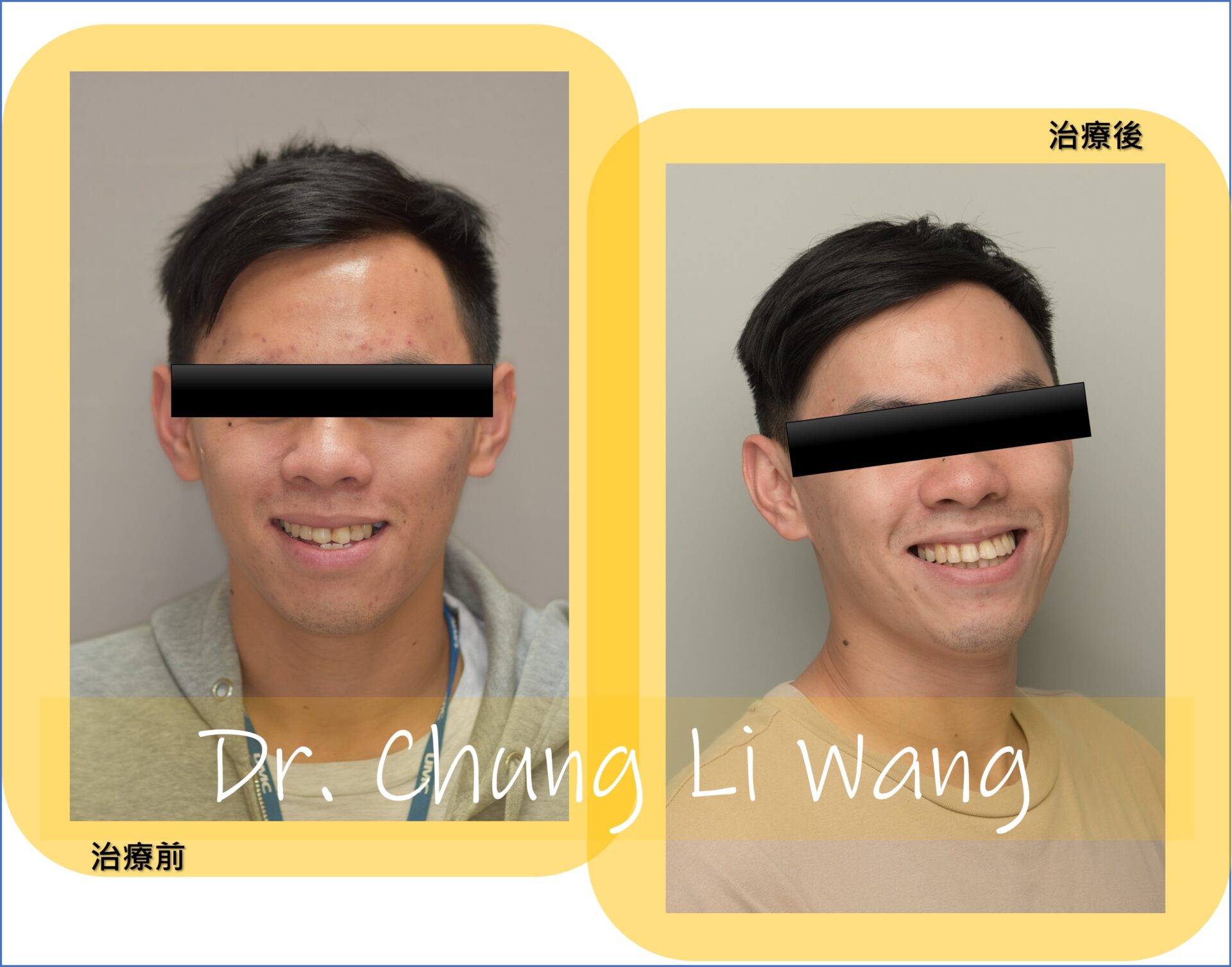 成人戽斗矯正治療-非手術治療